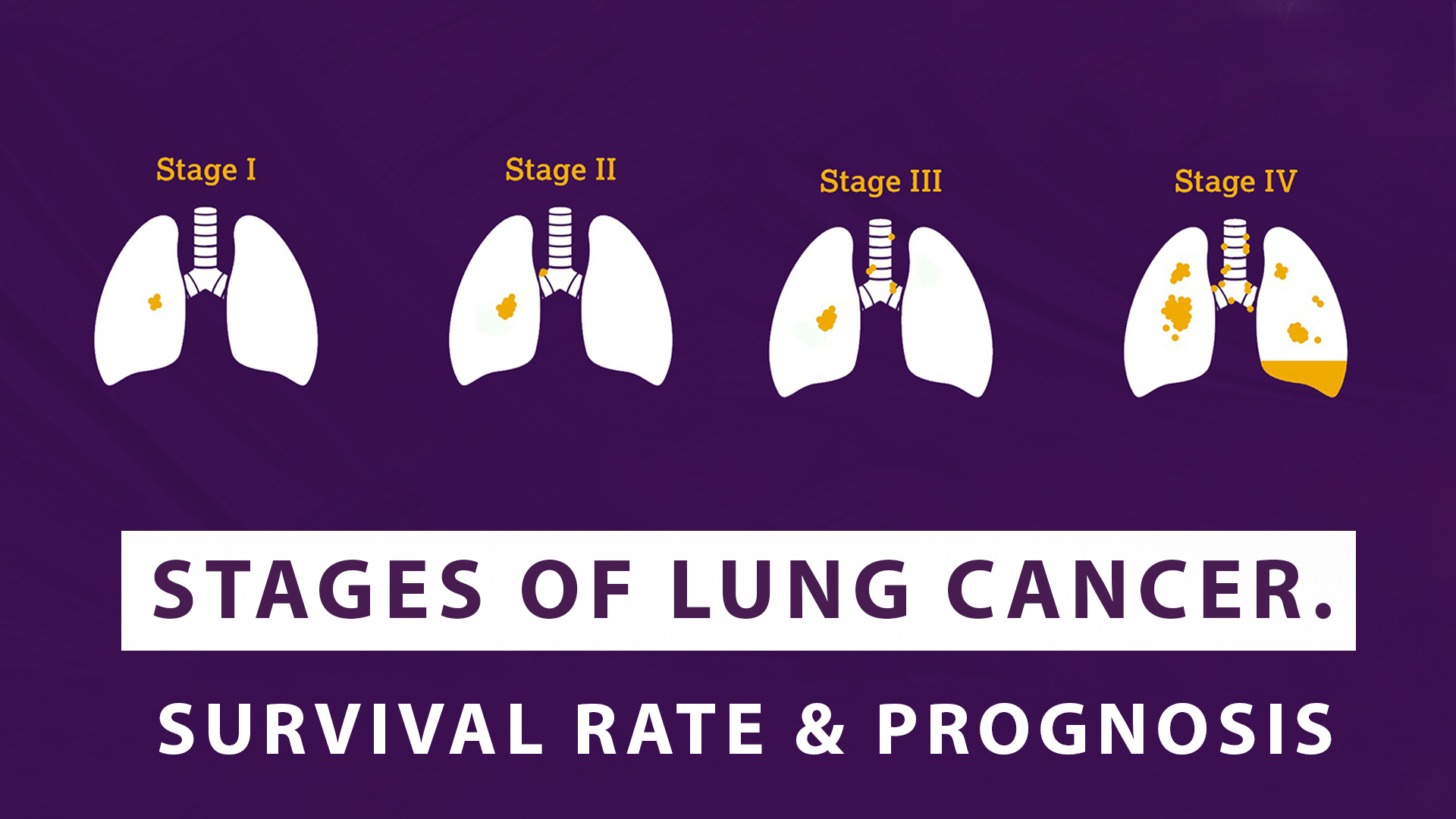 Prognosis stage 4 lung cancer