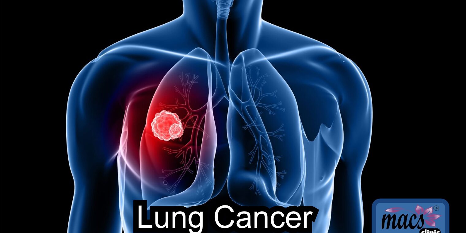 Lung Cancer Screening… How to Detect Early & Cure - Macs Blogs