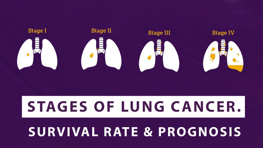 Survival Rate Of Squamous Cell Lung Cancer