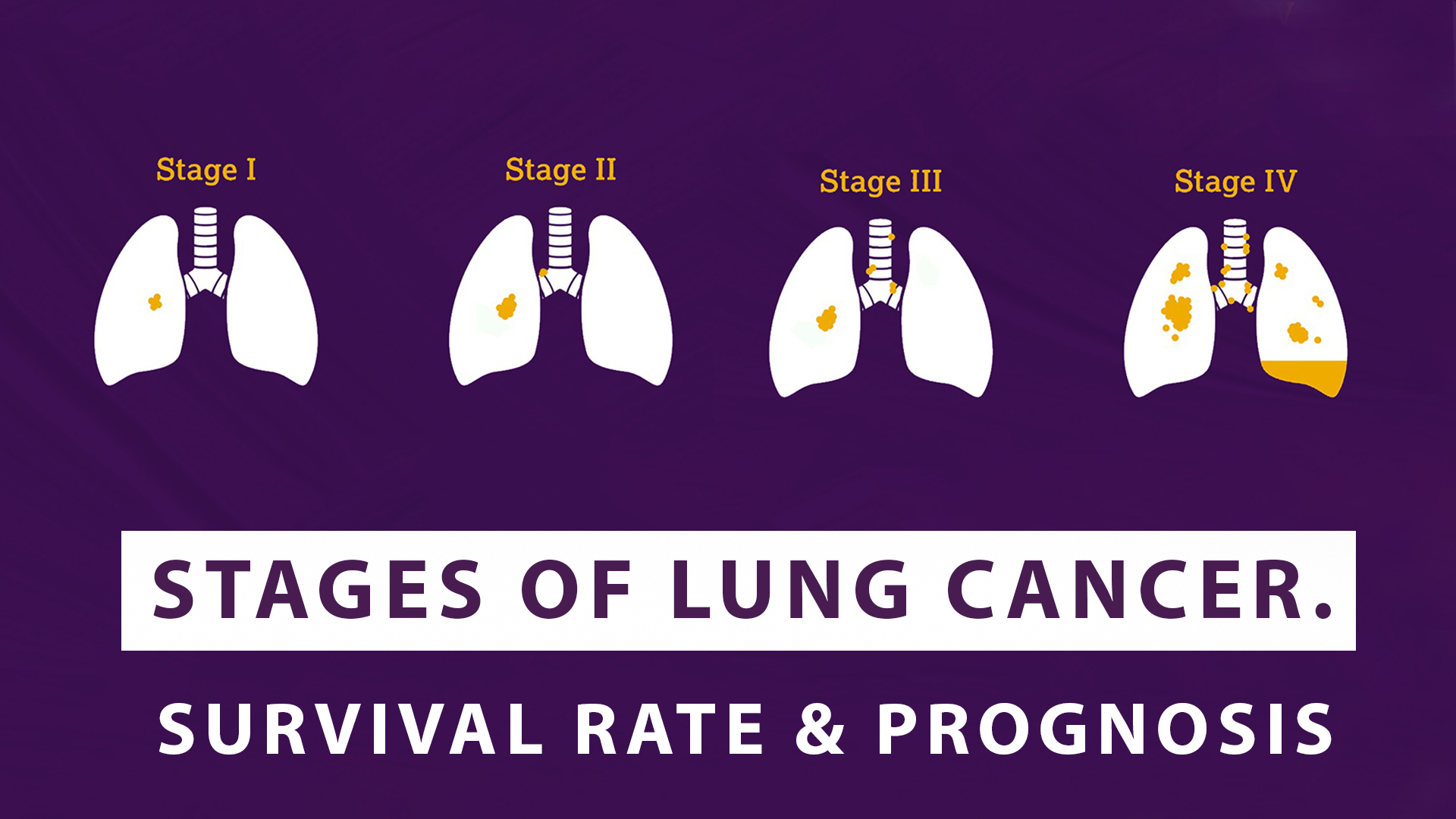Stages Of Lung Cancer – Survival Rate And Prognosis - Macs Blogs