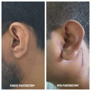 before after robotic parotidectomy