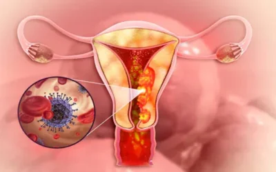 Recurrent Endometrial Cancer After Hysterectomy