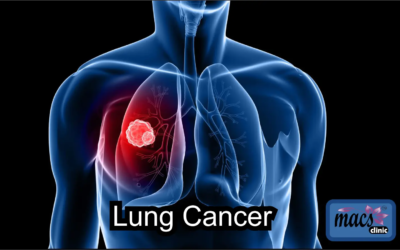 Lung Cancer Screening… How to Detect Early & Cure