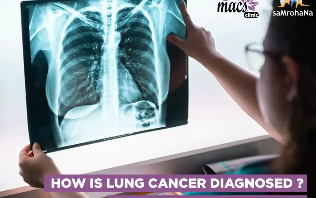 Diagnosis Of Lung Cancer And The Best Way To Treat It