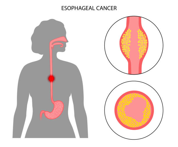 Colorectal (Colon) Cancer
