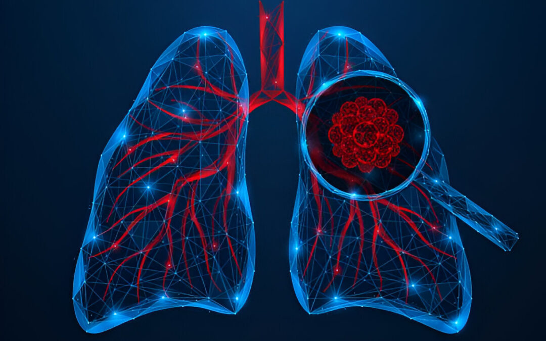 Combining Surgery and Immunotherapy: A New Era for Lung Cancer Patients
