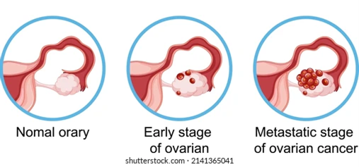 Diagnosing Colorectal Cancer