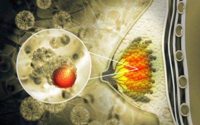 Can a Biopsy Trigger the Spread of Breast Cancer?