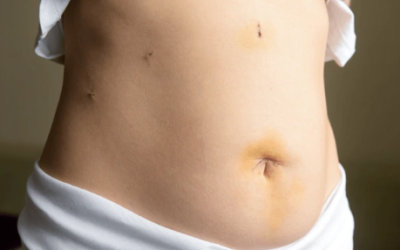 How long is the recovery after a laparoscopy?