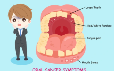 What Are the Symptoms of Oral Cancer