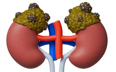 What Are the Symptoms of an Adrenal Tumor?