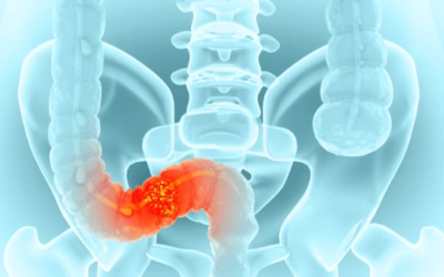 Colorectal Cancer Symptoms in Females