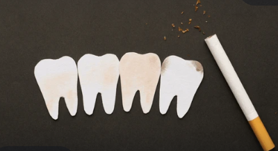 Smoking Causes Mouth Cancer