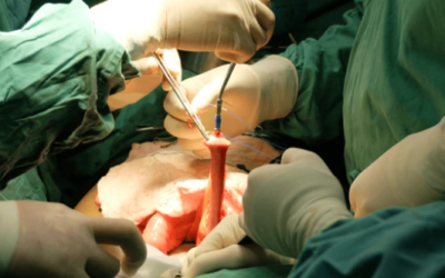 Laparoscopic Surgery for Colon Cancer