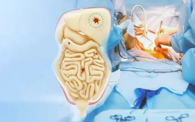 HIPEC Surgery Cost in India