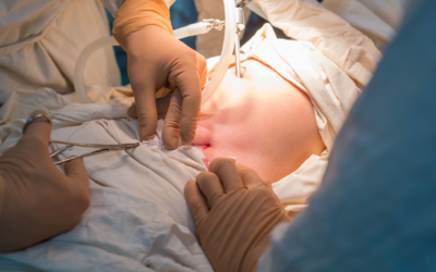 Laparoscopic vs Open Surgery for Cancer