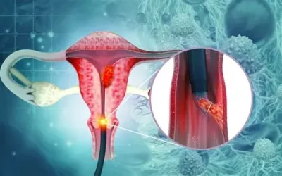 Early Signs of Cervical Cancer