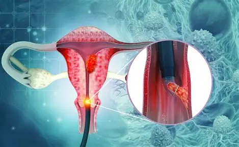 Early Signs of Cervical Cancer