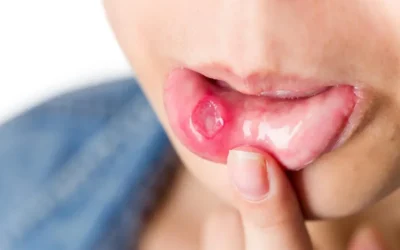 Early Signs of Oral Cancer