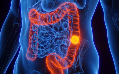 First Symptoms of Colon Cancer