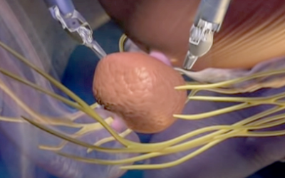 How Long Does Robotic Cancer Surgery Take?