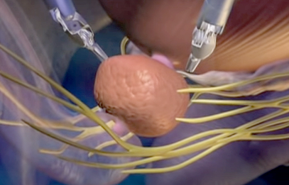 Close-up of a round, fleshy tissue mass during surgery with visible yellow nerves surrounding it and surgical instruments in the background.