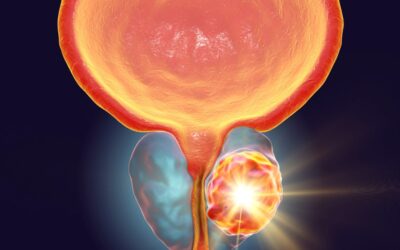 How to Detect Prostate Cancer Early?