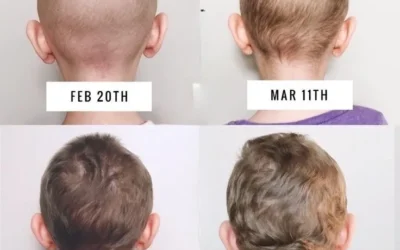 Hair Regrowth After Chemotherapy: Timeline and Tips