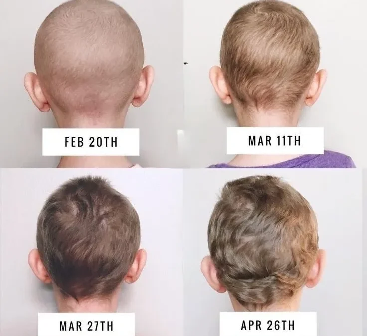 Hair Regrowth After Chemotherapy: Timeline and Tips