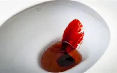 Is Blood in Stool Always Cancer?