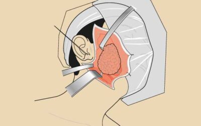 What Is Robotic Parotidectomy and Who Needs It ?
