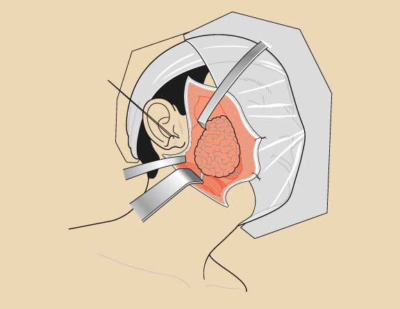 What Is Robotic Parotidectomy and Who Needs It