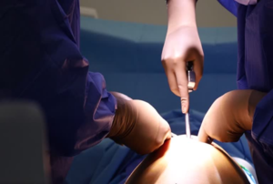 Two surgeons in blue gowns perform abdominal surgery, one using a scalpel while gloved hands work over the patient.