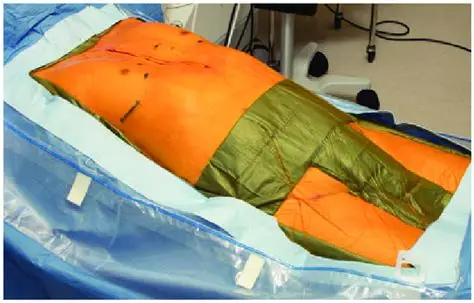 VEIL Procedure for Groin Node Surgery