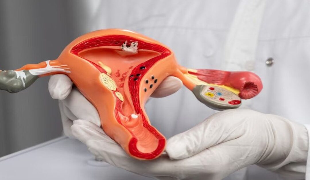 Warning Signs of Ovarian Cancer