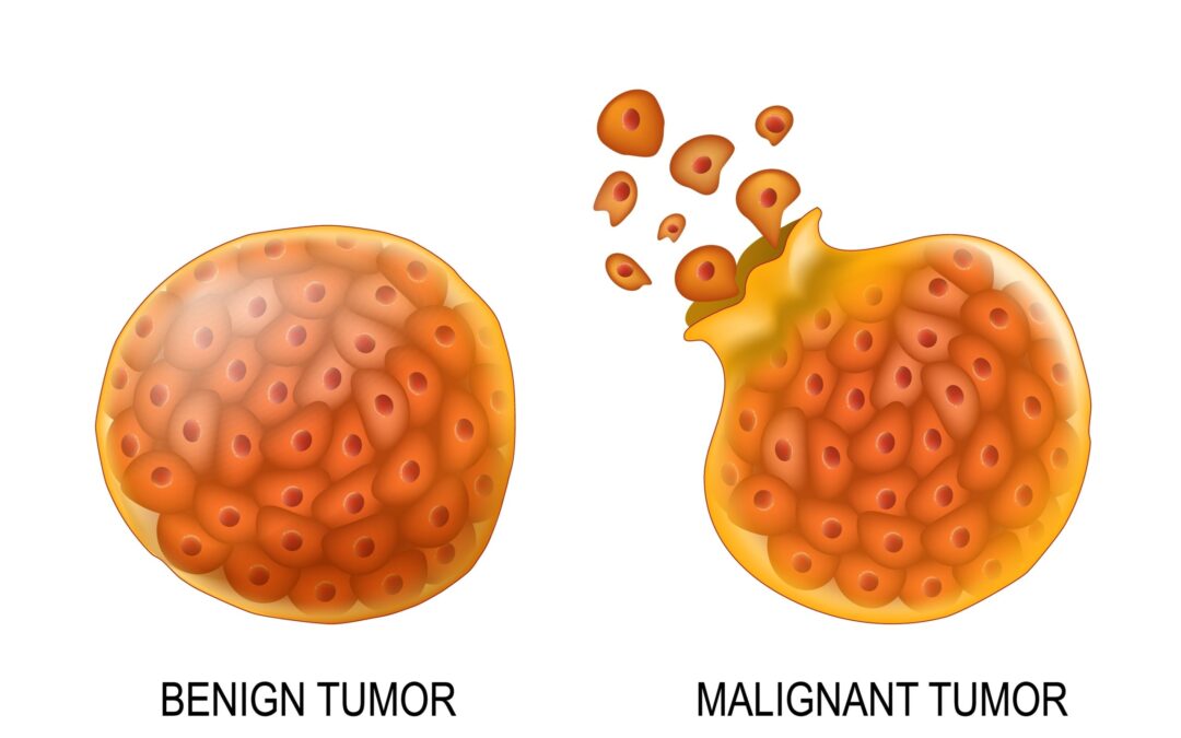 Benign vs Malignant Tumour Differences