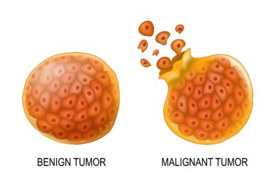 Benign vs Malignant Tumour Differences
