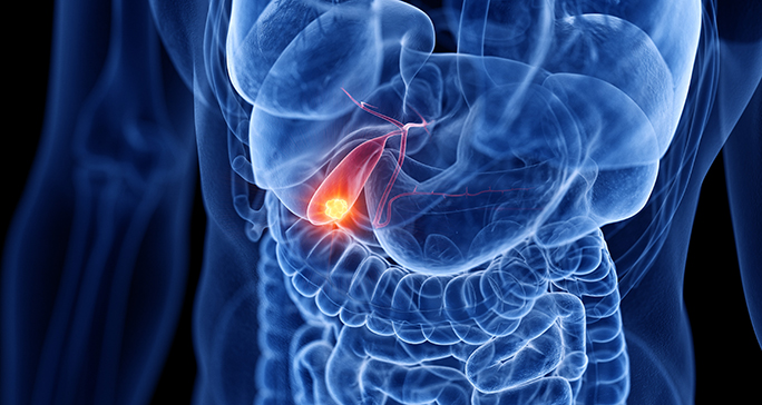 Medical illustration of the digestive system highlighting an inflamed appendix in the lower right abdomen.