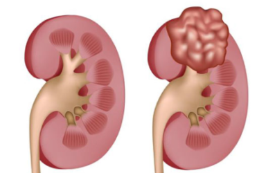 Early Signs of Kidney Cancer