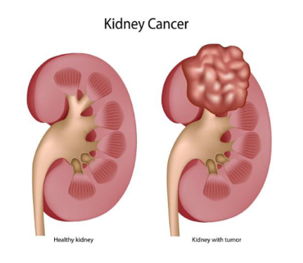 Two kidneys shown side by side: left is healthy, right shows a kidney with a tumor for contrast and education