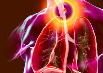Early Symptoms of Esophageal Cancer