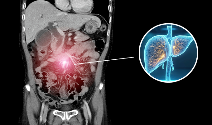 Coronal abdominal scan highlighting a tumor with a pink glow; inset shows lungs with a highlighted area indicating metastasis.