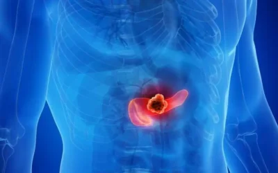 Warning Signs of Pancreatic Cancer