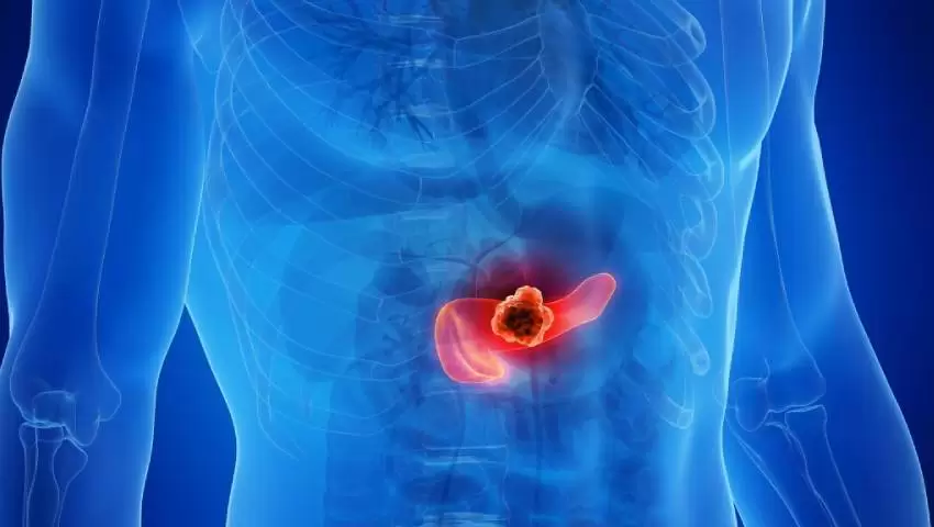 Translucent human torso with an orange-red pancreatic tumor highlighted in the abdomen, illustrating pancreatic cancer.