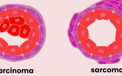 What Is Carcinoma Types and Differences?