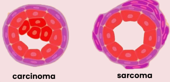 What Is Carcinoma Types and Differences - Dr sandeep Nayak