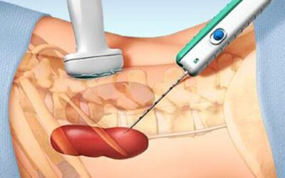 What Is a Biopsy and Is It Painful?