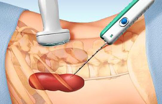 What Is a Biopsy and Is It Painful