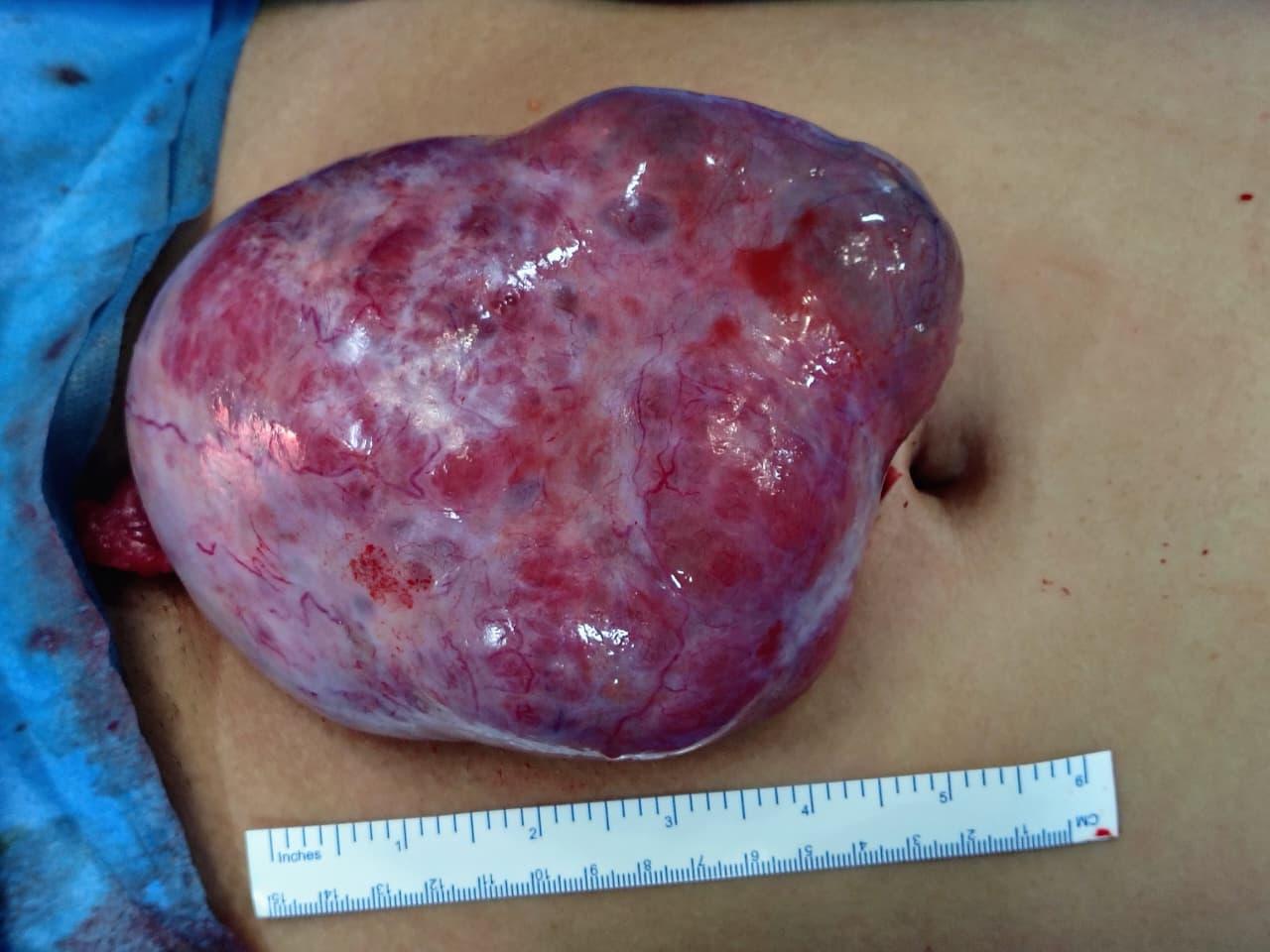 Large, vascular, purple-red surgical mass on the abdomen, measured with a ruler (about 6 inches).