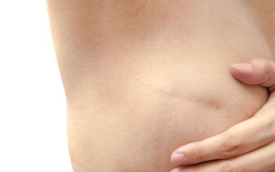 Can Breast Cancer Be Managed Without Removing the Breast?